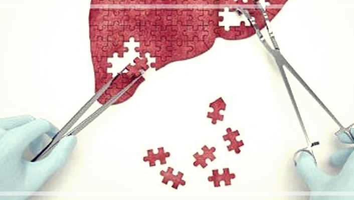 간이식 기증자 조건 간이식 조건 나이 검사 부작용 회복기간