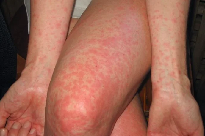 일광 두드러기 증상 예시