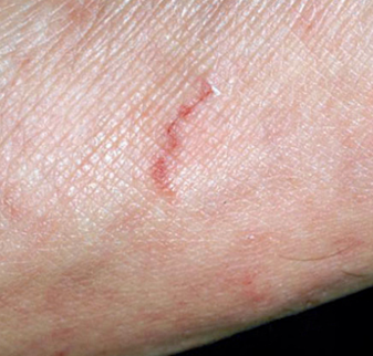 옴이 굴을 만든 사진