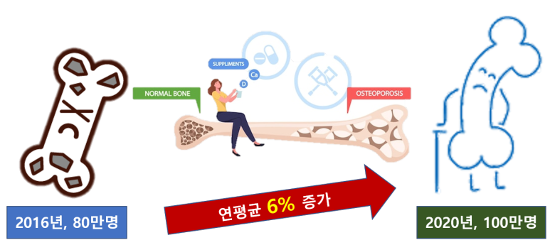 골다공증 환자 추이
