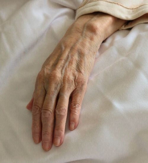 손등 검버섯 없애는 법