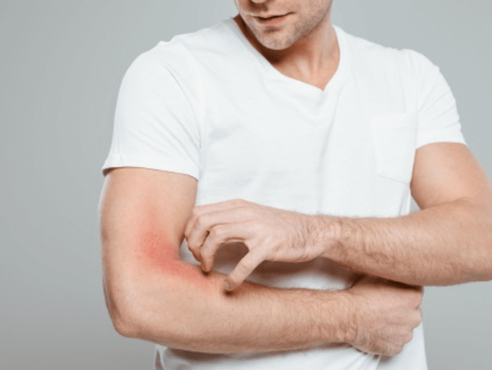 사타구니 습진의 증상