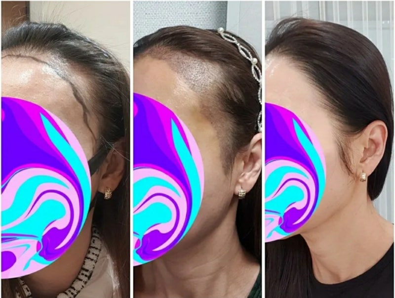 모발이식 전 시술직후 시술3개월후