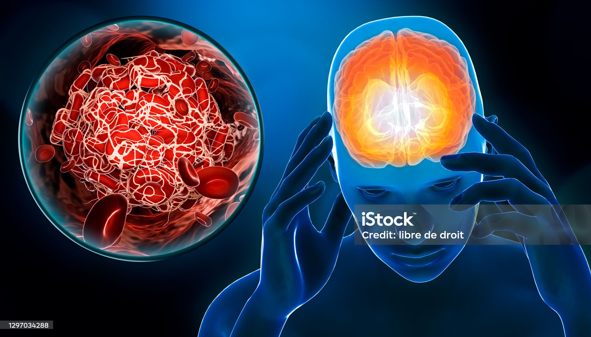 혈관성치매 관련 사진
