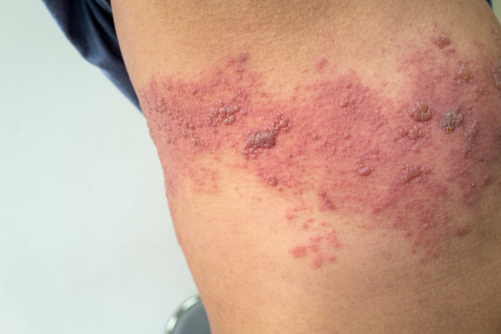대상포진(Shingles, Herpes Zoster): 원인, 증상, 치료 및 예방법 총정리
