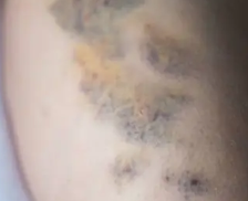 피부 붉은반점 3