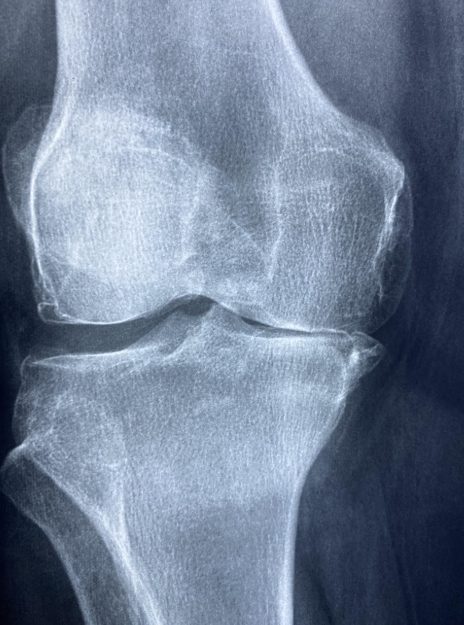 무릎 엑스레이 사진