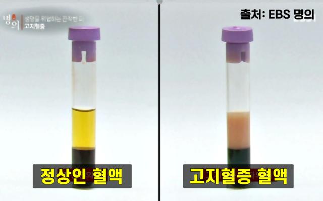허리둘레 85cm 33인치 고지혈증,팁줌