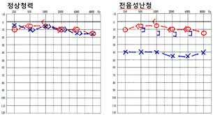 보청기-종류-가격-보조금-귀걸이형-귓속형-삽입형