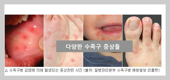 수족구병: 원인, 증상, 예방 및 관리 방법 총정리