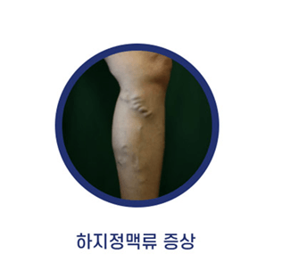 하지정맥류-다리가-붓는-이유