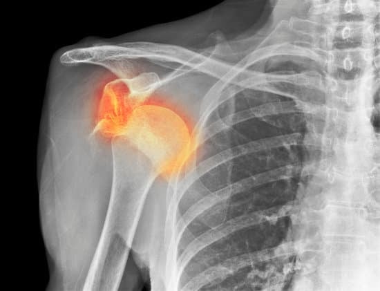 견관절 탈구 (Shoulder Dislocation): 원인, 증상 및 치료