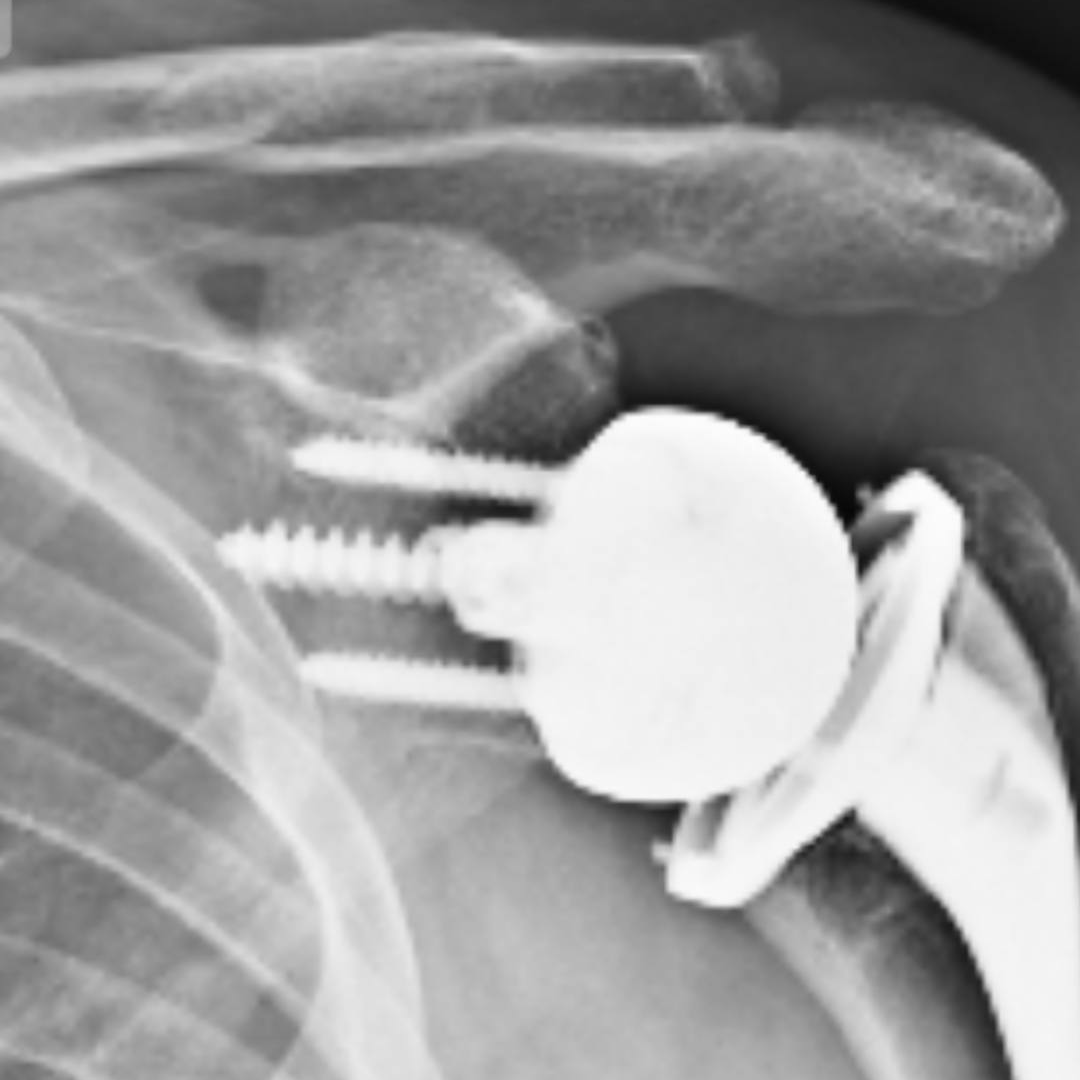 상완골 골절 핀 제거 시기