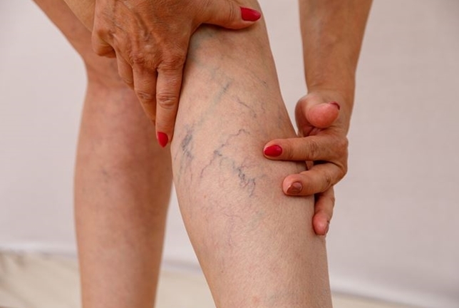 하지정맥류 관련 이미지