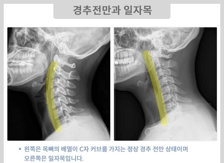 경추 전만과 일자목
