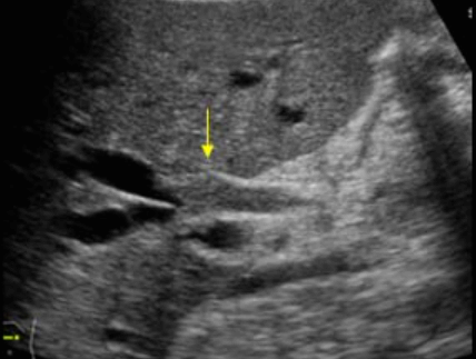간외담관암(extrahepatic cholagiocarcinoma)
