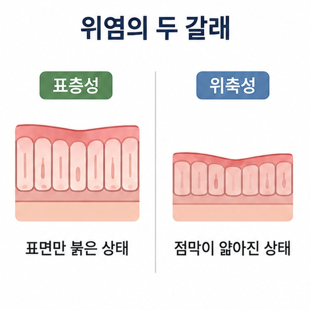 표층성 위염과 위축성 위염 비교 도해, 점막 표면에 머문 염증과 점막이 얇아진 상태를 나란히 그린 단면도