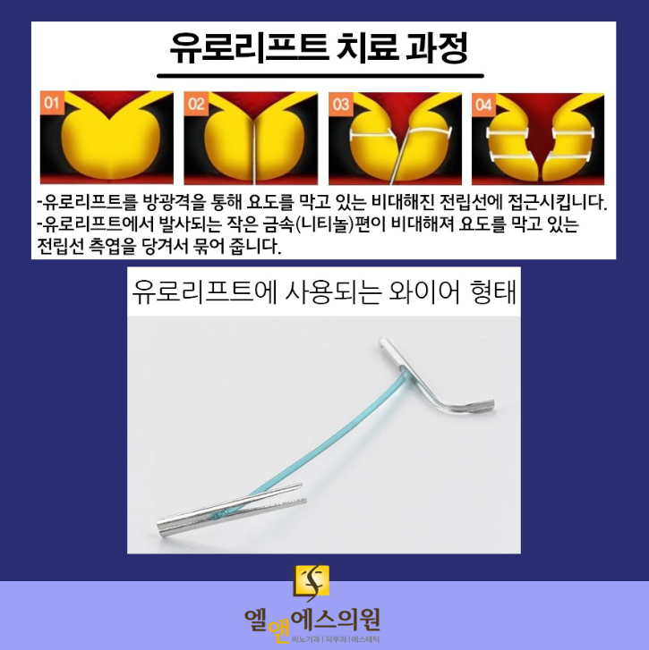 유로리프트 시술 과정
