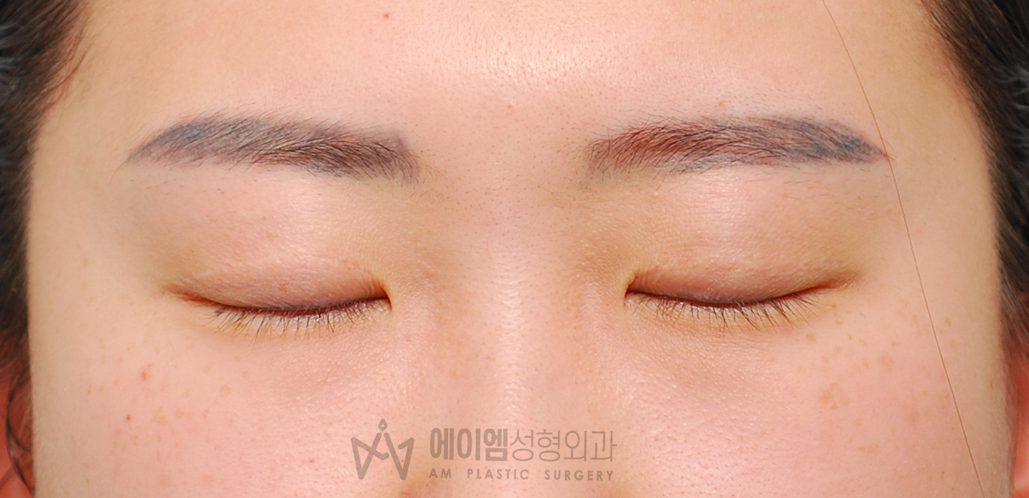 소세지눈 수술 전 눈감은사진