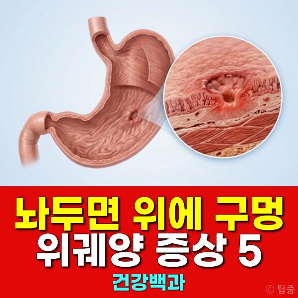 위궤양 증상