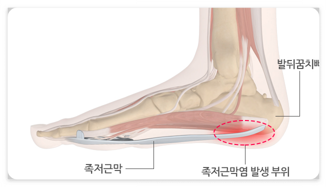 족저근막염 발생부위 그림