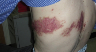 대상포진이미지