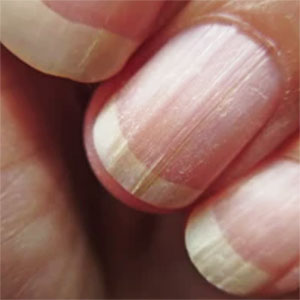 손톱-세로줄-무늬