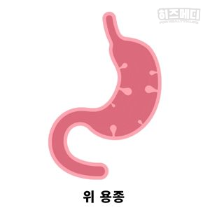 위저선 용종