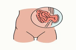 탈장-증세