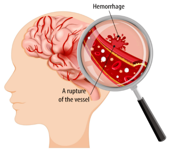 프랭크증후군-사진2