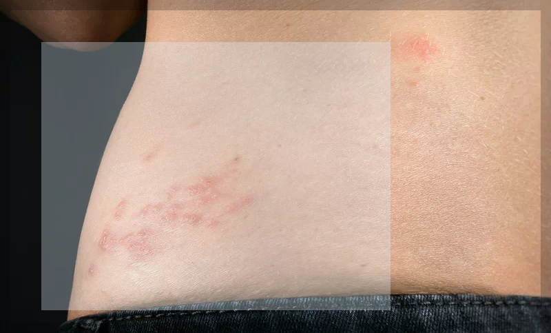 대상포진 수포