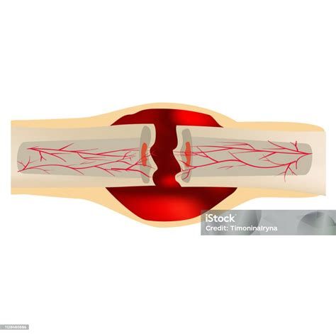 뼈골절 수술비용