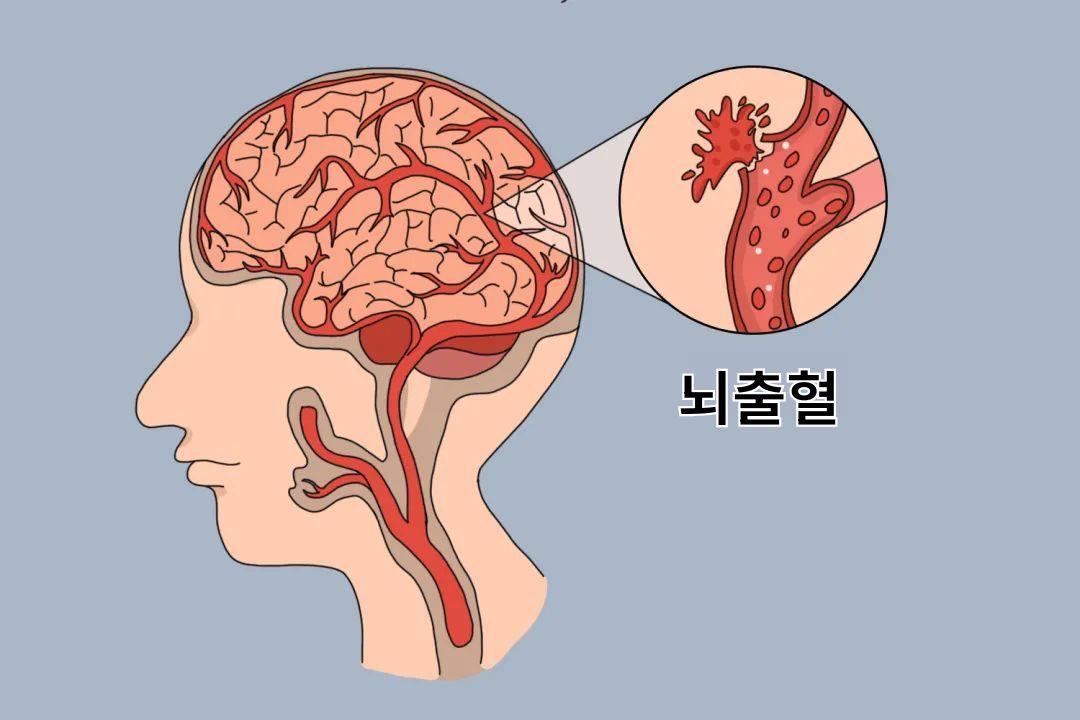 뇌출혈 이란