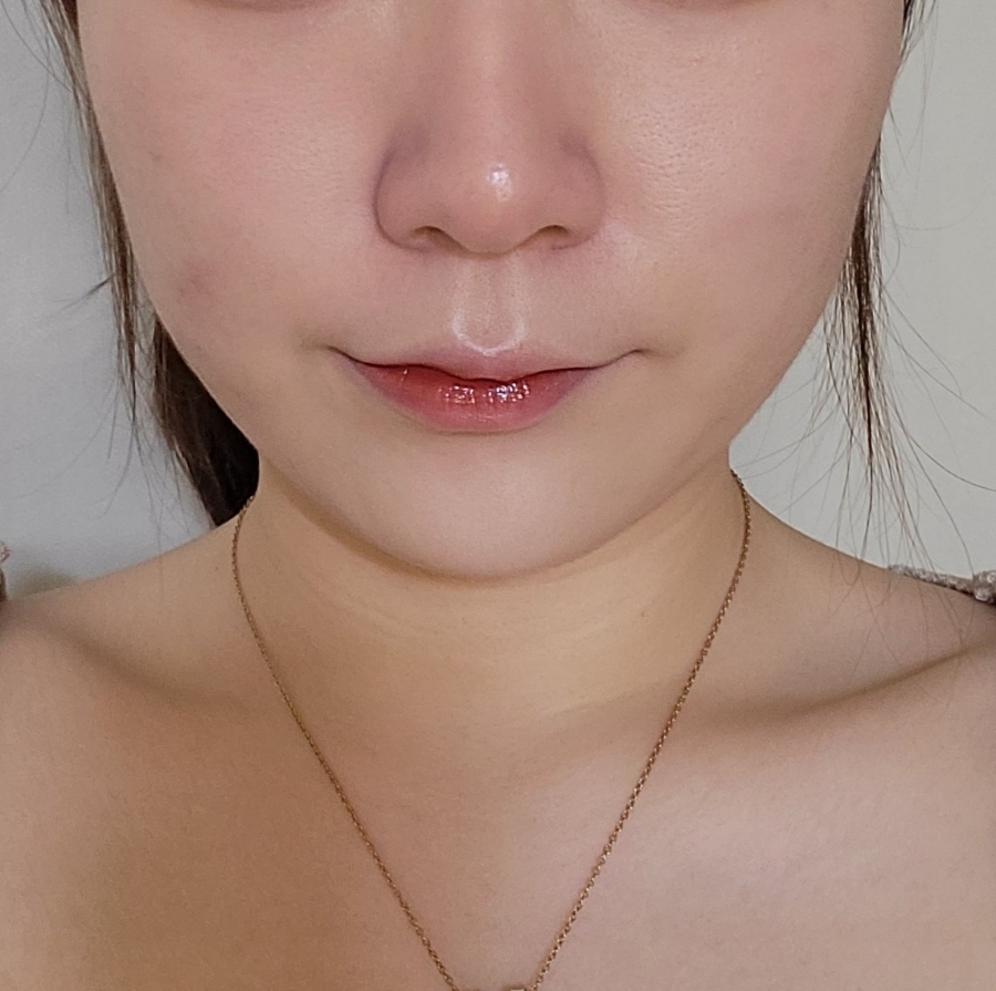 bbl 레이저 후기