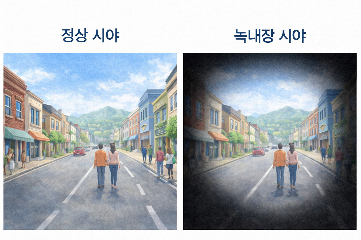 정상 시야와 녹내장 시야의 차이점