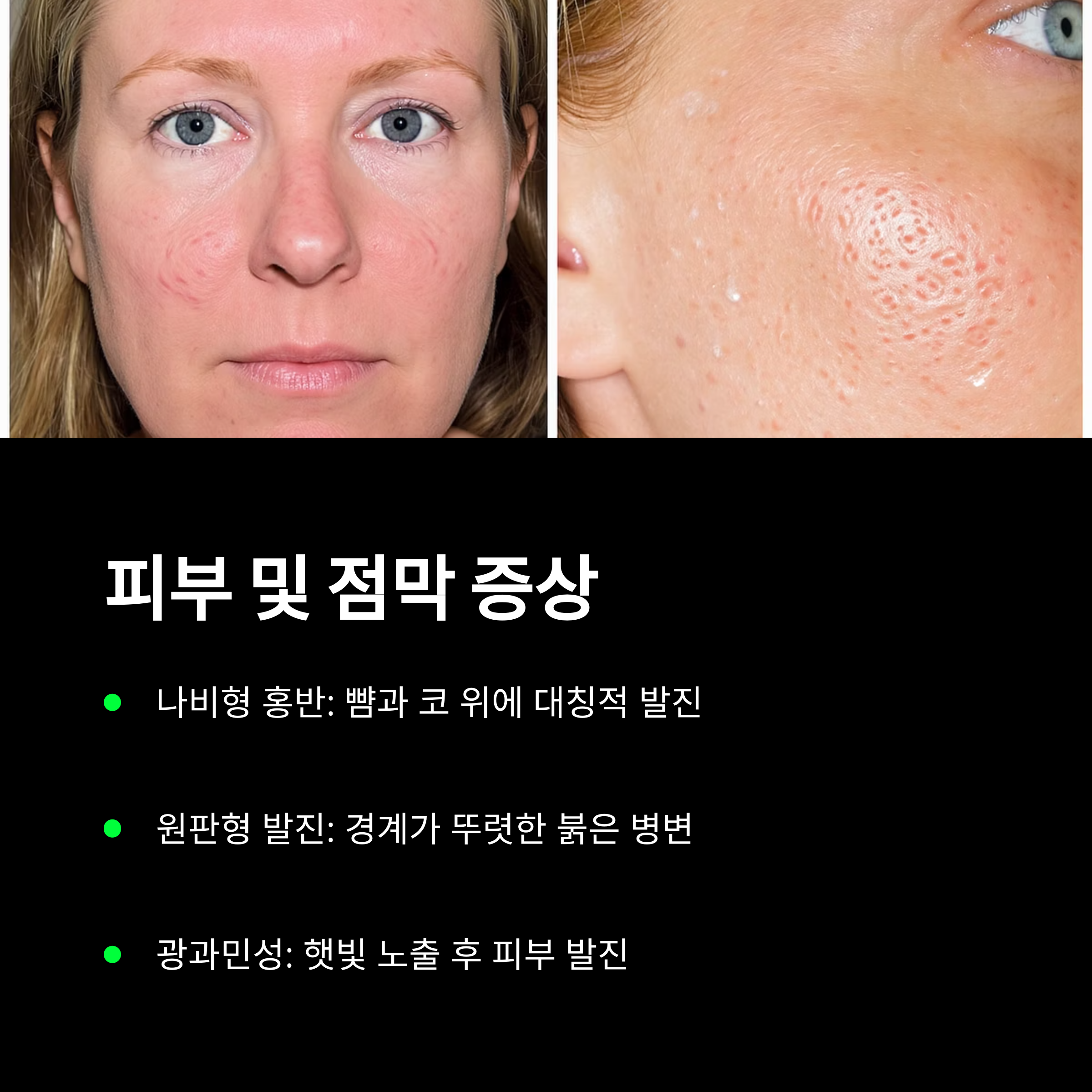 루푸스병의 피부 및 점막 증상 예시와 나비형 홍반, 원판형 발진, 광과민성에 대해 설명한 이미지