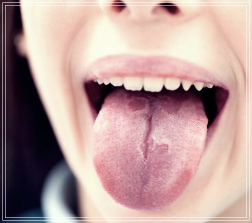 혀 갈라짐 원인 치료방법과 좋은 음식들