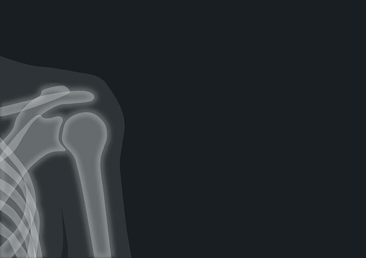 콘드로이친-효능-후기-무릎-과절염-퇴행성관절염1