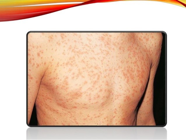 "돌발진"이 난 모습