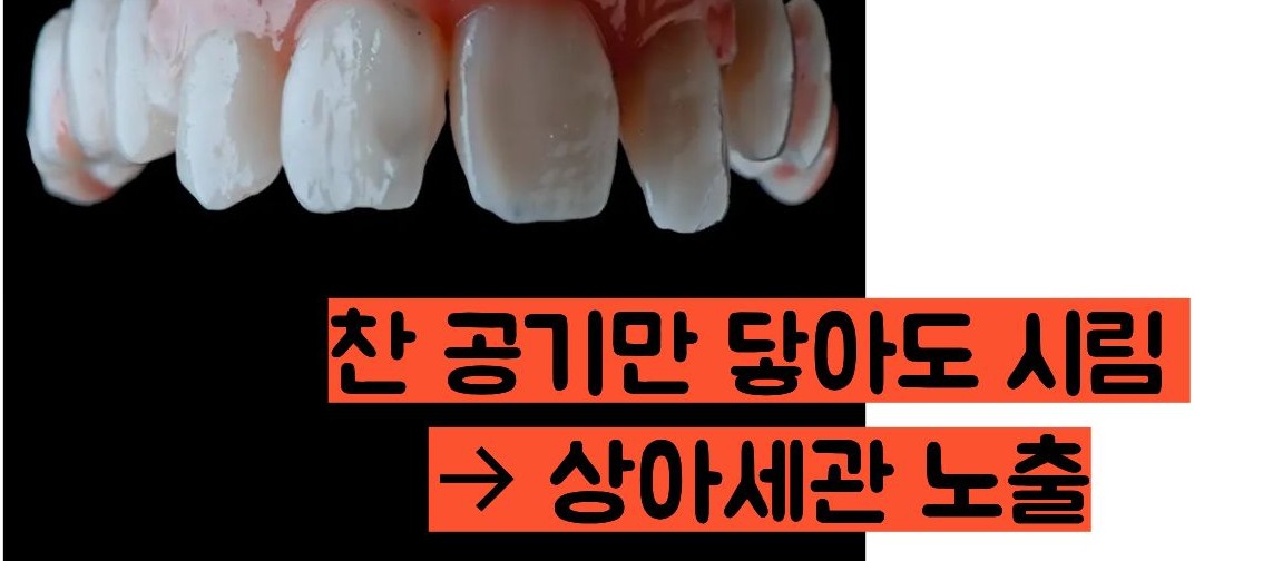 이빨이 시린 이유