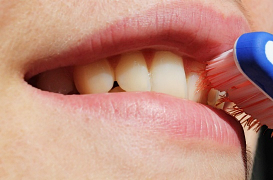 편도결석-이미지