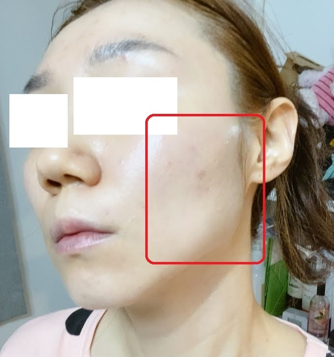 얼굴지방이식후기