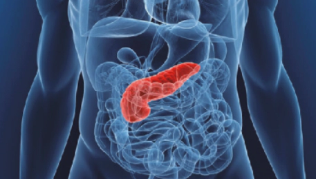 췌장암-초기증상