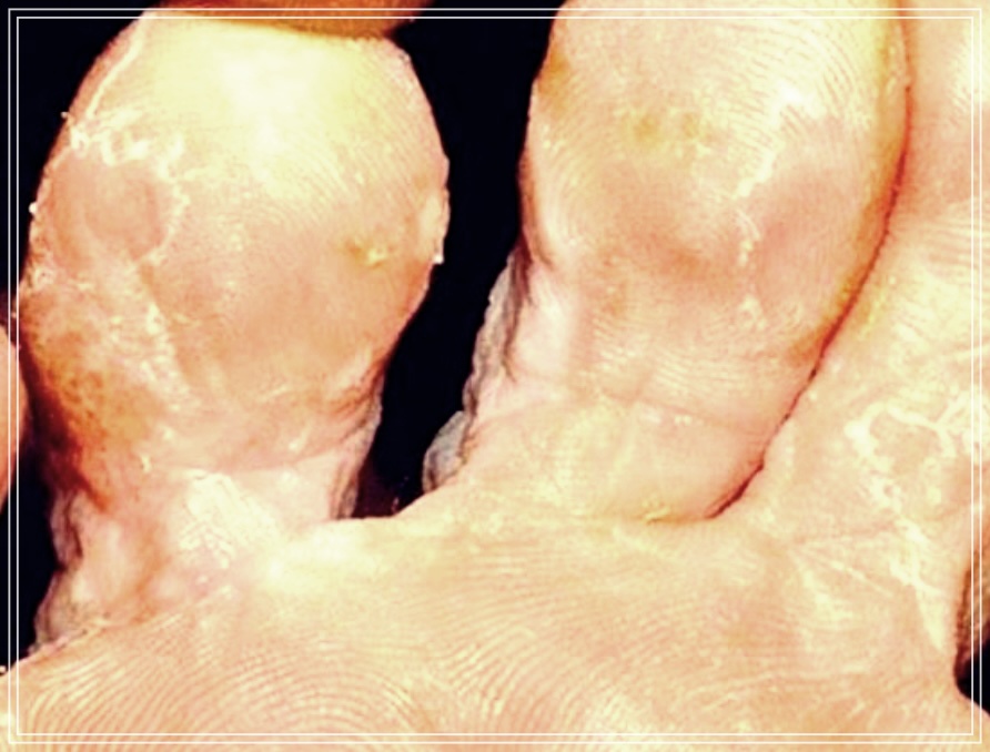 카네스텐 연고 가격 피부 무좀 치료 방법