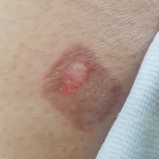 화상 물집 치료방법, 터뜨리지 말고 이렇게 치료하세요!