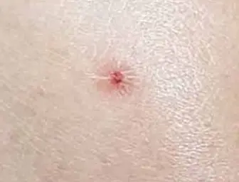 SFTS 중증열성혈소판감소증후군 증상 4가지