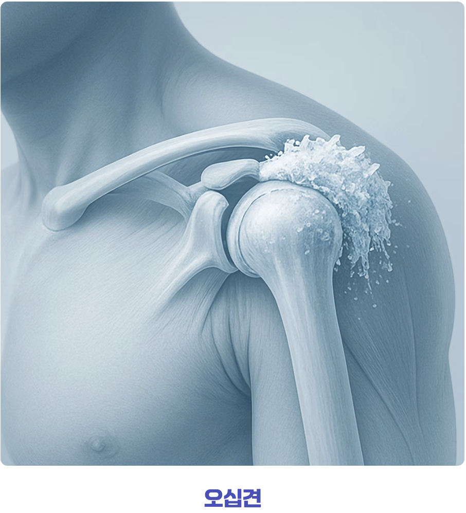 오십견과 다른&amp;#44; 결정적인 증상의 차이