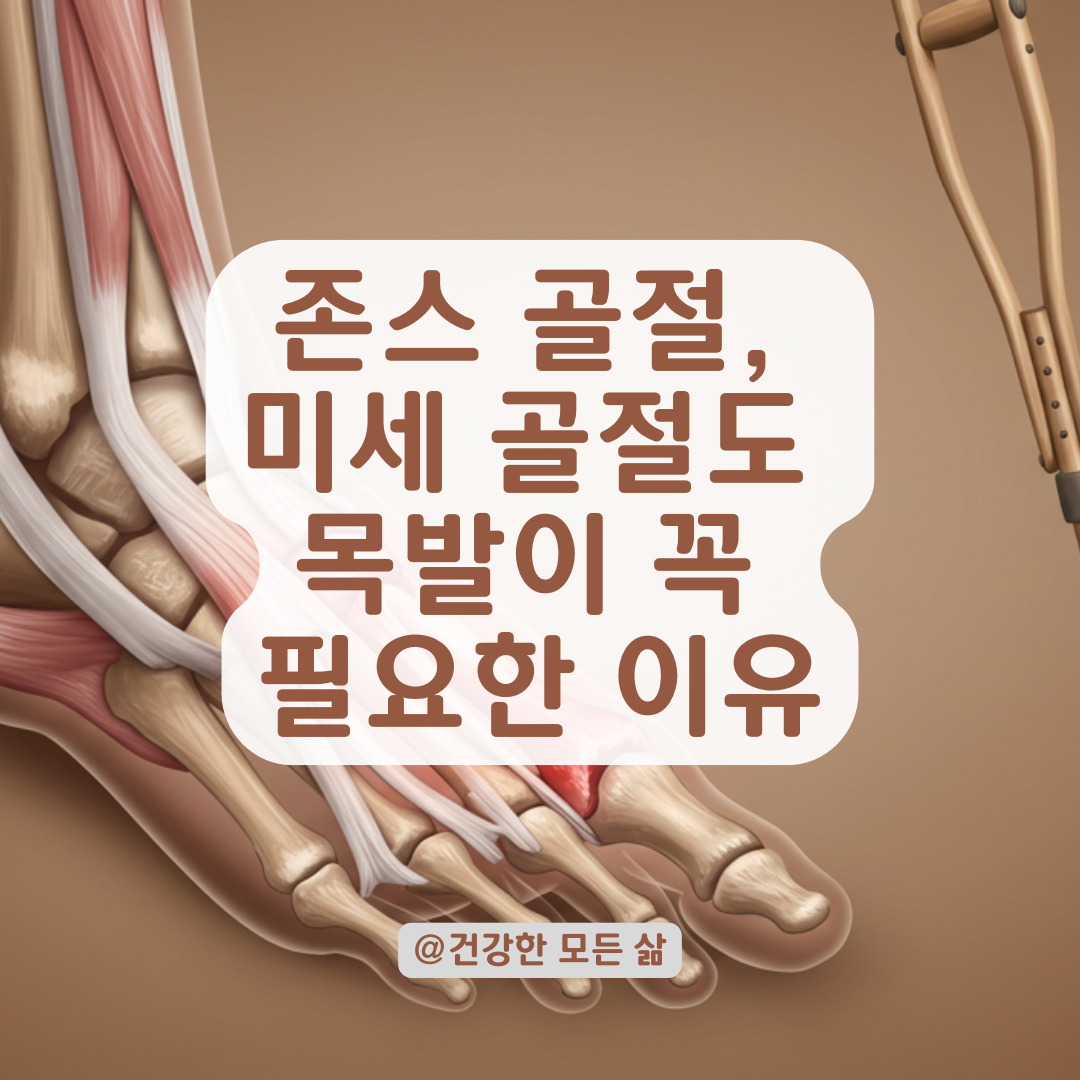 미세한 존스 골절이라도 목발 없이 걸으면 생기는 회복 지연 위험사례 필독!
