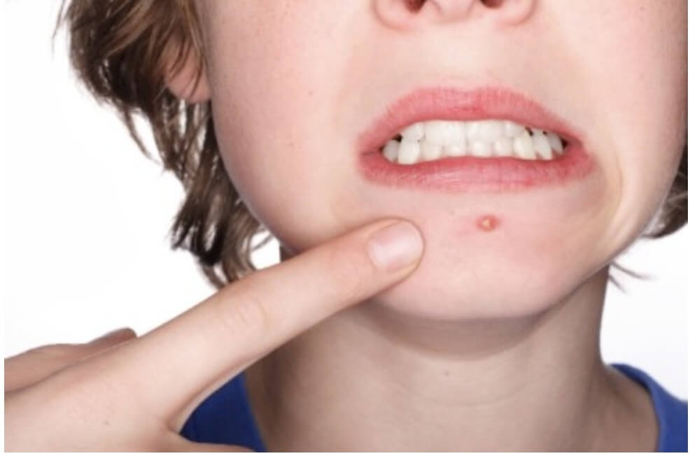 입 아래 피지가 나있는 남자의 모습