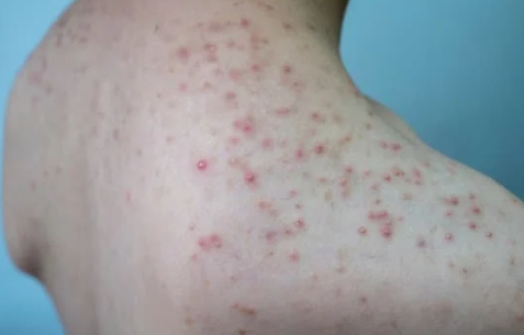 모낭염 원인과 치료방법